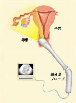 子宮卵管造影検査イメージ
